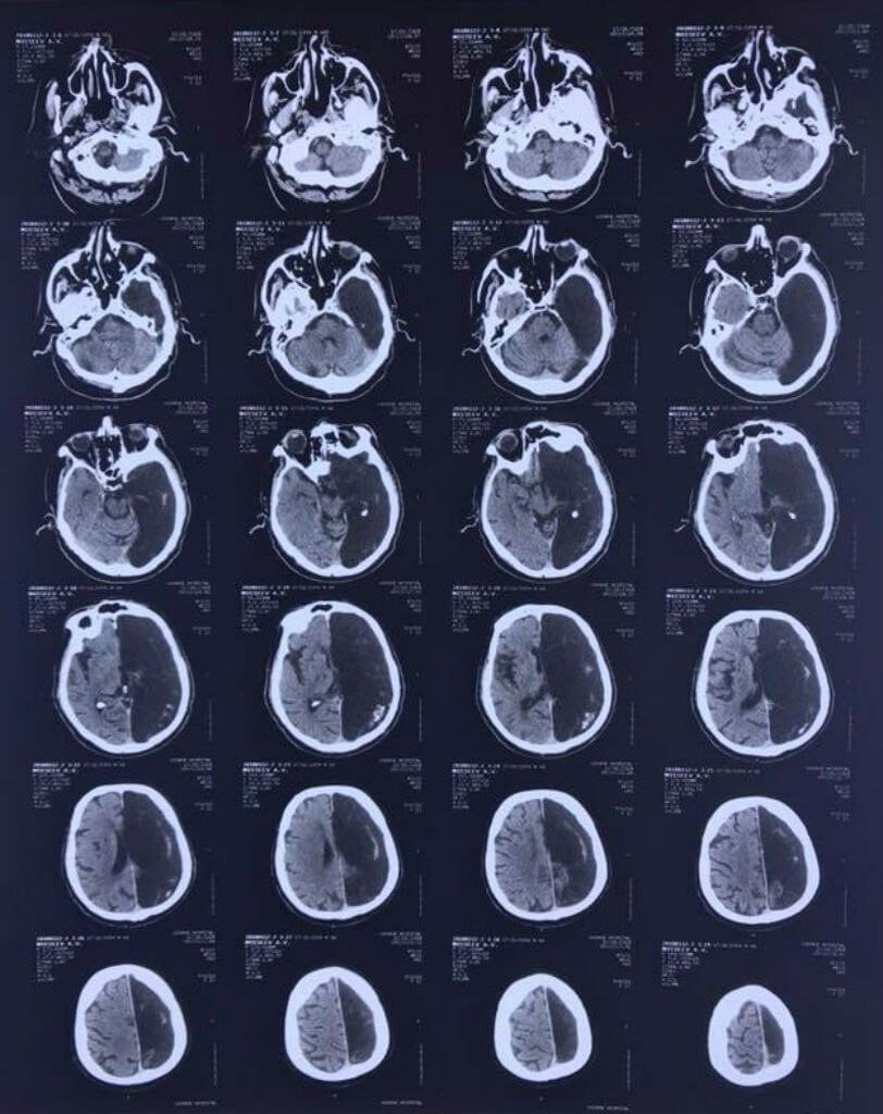 Brain scan with half of brain missing